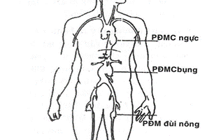 giải phẫu các vị trí phình động mạch